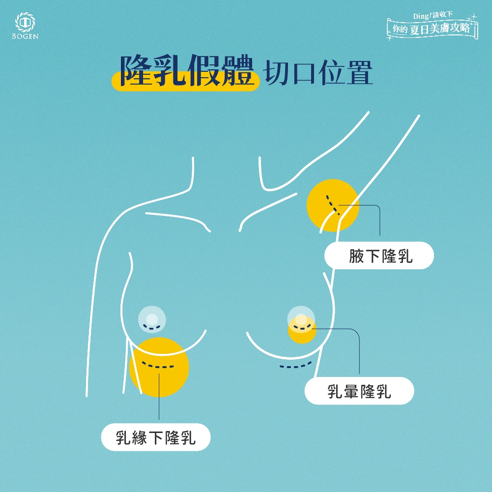 隆乳假體植入切口位置,隆乳手術,博恩妍